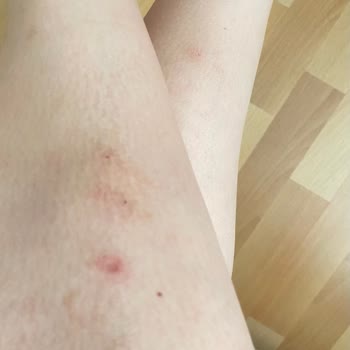 Shinest Estetik Halkalı Vücudumu Yaktı Hala Lekeler Kararmalar Geçmedi