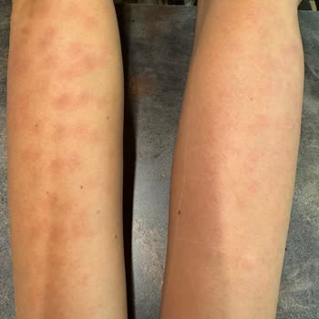 Shinest Estetik Halkalı Vücudumu Yaktı Hala Lekeler Kararmalar Geçmedi