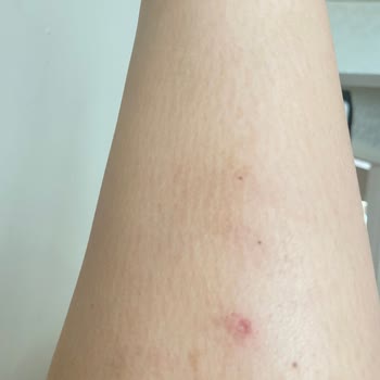 Shinest Estetik Halkalı Vücudumu Yaktı Hala Lekeler Kararmalar Geçmedi