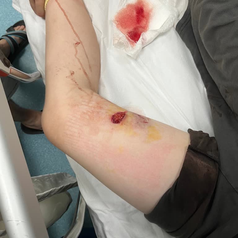 İBB - İstanbul Büyükşehir Belediyesi Parkta Top Oynarken Köpek Isırdı.