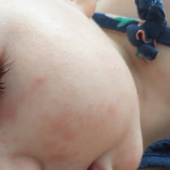 İburamin Zero Kullandıktan Sonra Yüzünde Kızarıklıklar Çıktı