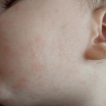 İburamin Zero Kullandıktan Sonra Yüzünde Kızarıklıklar Çıktı