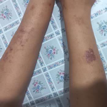 Estedermal Life (Sivas) Lazer Uygulaması Sonrası Yanık Problemi