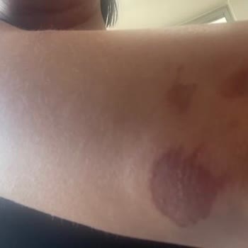 Ephesia Resort Hotel Dikkatsizlik Sonucu Yaşanan Olayda Bir Özür Bile Dilenmemesi