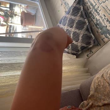 Ephesia Resort Hotel Dikkatsizlik Sonucu Yaşanan Olayda Bir Özür Bile Dilenmemesi