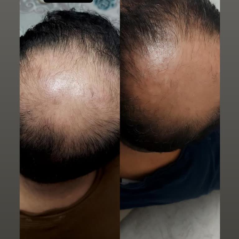 Venice Estetik & Güzellik Saç Vitamini Yalanı