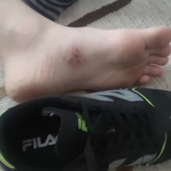 Deichmann FILA Hallenschuhe verursachen Blasen bei Kind, Rückgabe verweigert