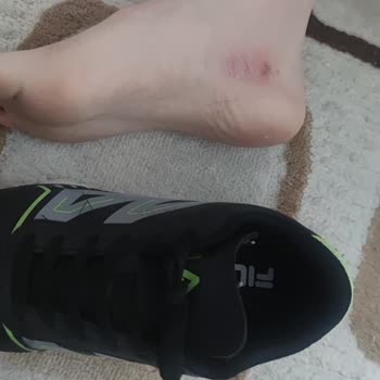 Deichmann FILA Hallenschuhe verursachen Blasen bei Kind, Rückgabe verweigert