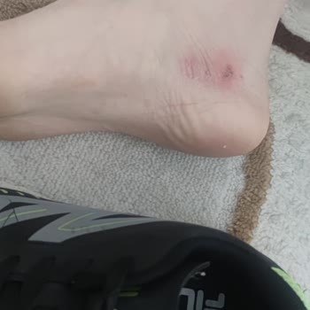 Deichmann FILA Hallenschuhe verursachen Blasen bei Kind, Rückgabe verweigert