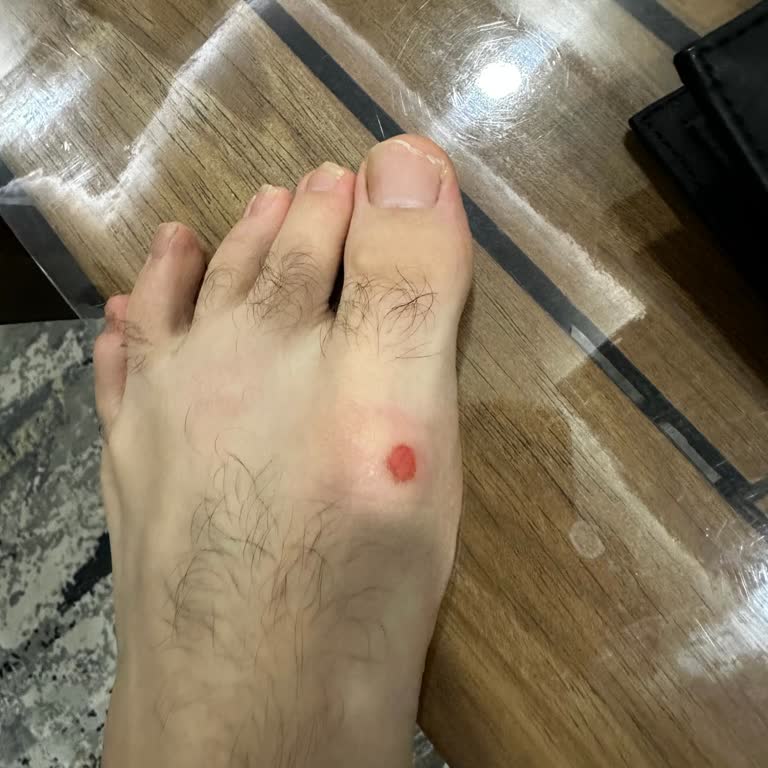 Crocs Terlik & Ayakkabı Sıcakta Ayağımı Yara Etti