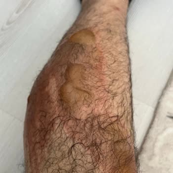 Koru Hastanesi Sincan Özel Koru Ücretsiz Muayene Yapması Gerekirken Haksız Para Alıyor