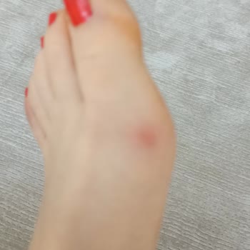 Birkenstock Sandalen Franca SFB Nu verursacht Fußschmerzen wegen schlechter Qualität