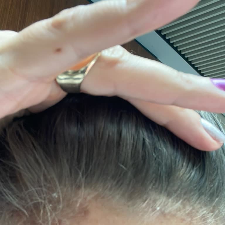 Lounge Marine Kuaför 'de Saçım Ve Alnım Yandı