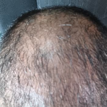 Doctor Zen Clinic Sac Ekimi Pişmanlığı