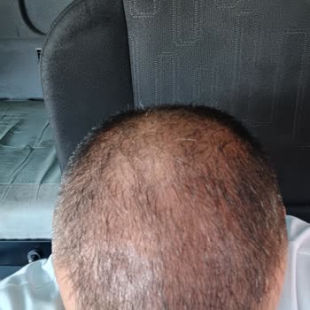 Doctor Zen Clinic Sac Ekimi Pişmanlığı