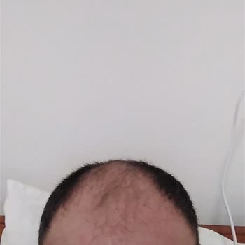 Doctor Zen Clinic Sac Ekimi Pişmanlığı