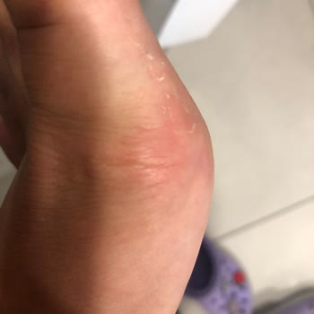 Deichmann Sandaletler Ayaklarımı Mahvetti, İade Kabul Edilmedi!