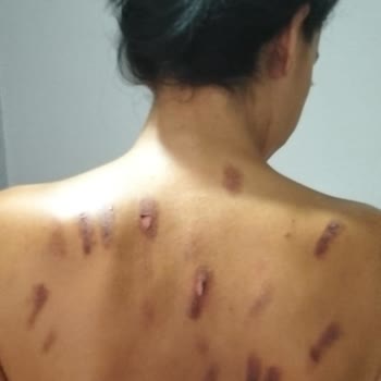 Mabel Güzellik Merkezi Lazer Epilasyon Yanığı