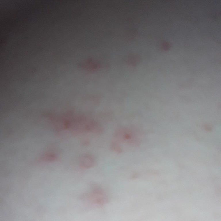 Sağlık Bakanlığı Uyuza Care Arıyorum