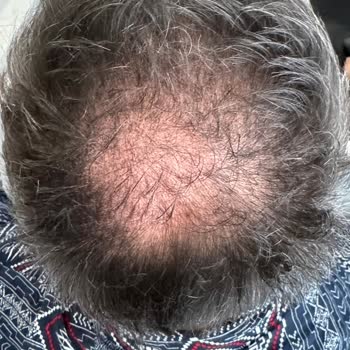 Batçı Hair Atelier Batçı Saç Kapatıcı