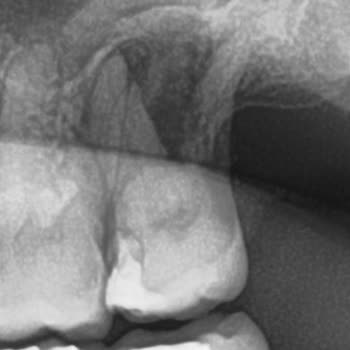 Hospitadent Dolgu Kalitesi :(