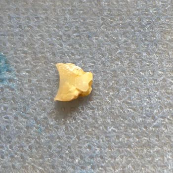 Hospitadent Dolgu Kalitesi :(