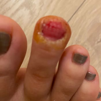 The X Belek Kaydıraktan Tırnaksız Çıktım!