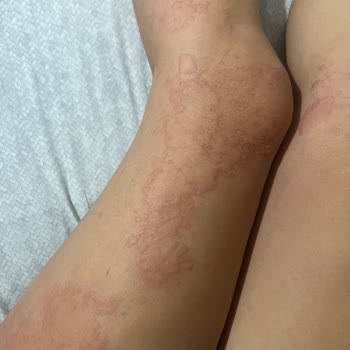 Bade Natural Ürtikere Yol Açtı