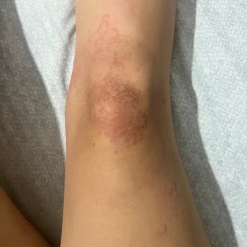 Bade Natural Ürtikere Yol Açtı