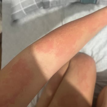 Bade Natural Ürtikere Yol Açtı