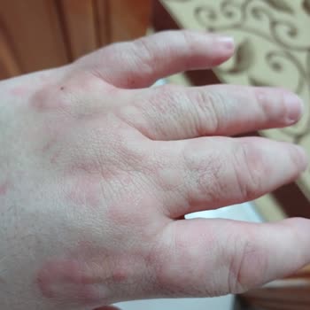 Barifit Alerji Yaptı İade Alınmadı