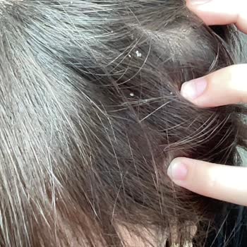 Loreal Paris Elseve Hydra Hyaluronic Saç Kremi Kaşıntı Ve Kepek Sorunu