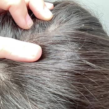 Loreal Paris Elseve Hydra Hyaluronic Saç Kremi Kaşıntı Ve Kepek Sorunu