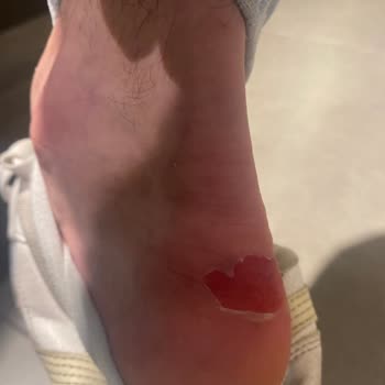 Deichmann Ayakkabıdan Yara Oluştu Yürüyemiyorum Tedavi Görmeye Başladım