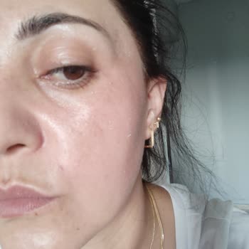 Yves Rocher Leke Sorunu Ve Soyulma