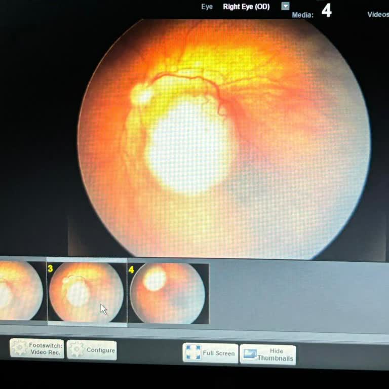 Doruk Yıldırım Hastanesi Göz Muayenesinde Farkedilmeyen Tümör Şikayeti