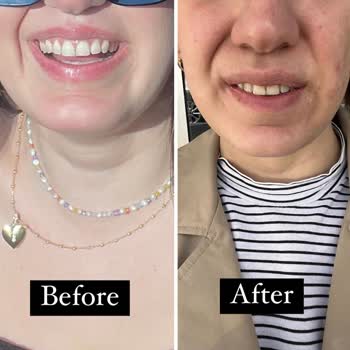 Dr. Ekrem Keskin Botox-Behandlung führte zu asymmetrischem und verzerrtem Gesicht