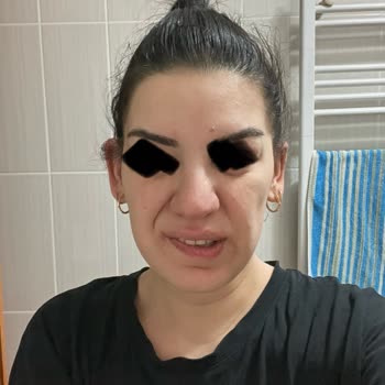 Dr. Ekrem Keskin Botox-Behandlung führte zu asymmetrischem und verzerrtem Gesicht