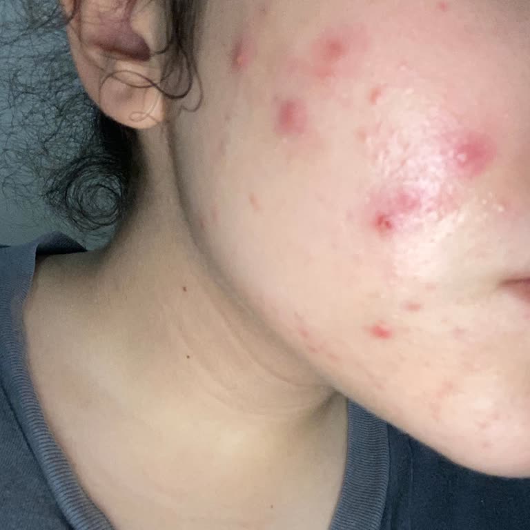 Gratis Beaulis Kapatıcı Kocaman Sivilce Yaptı