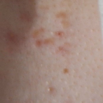 Trendyol Kiperin Kolajen Alerji Yaptı