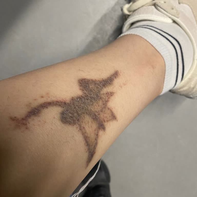 By _beautystudio_ (Instagram) Dövme Silme İşlemi Sorunu