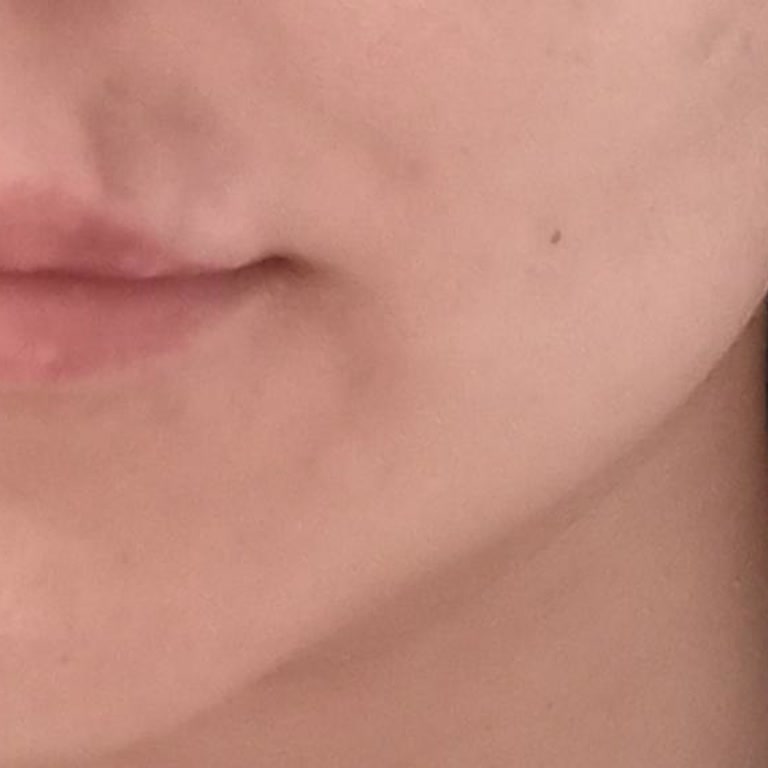 Radikal Klinik Dolgu İşlemi!