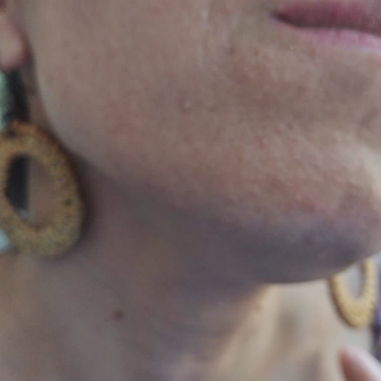 Esse Life İzmir Lazer Sonrası Cilt Bakımı