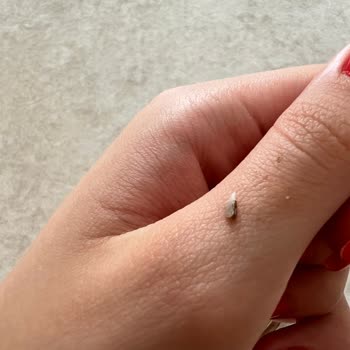 Marmara Üniversitesi Diş Hekimliği Fakültesi Kırık Diş Parçası Bıraktı