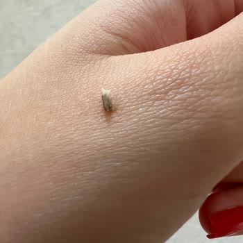 Marmara Üniversitesi Diş Hekimliği Fakültesi Kırık Diş Parçası Bıraktı