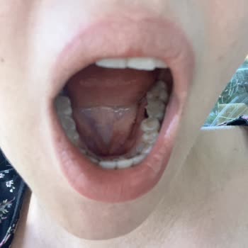 Marmara Üniversitesi Diş Hekimliği Fakültesi Kırık Diş Parçası Bıraktı