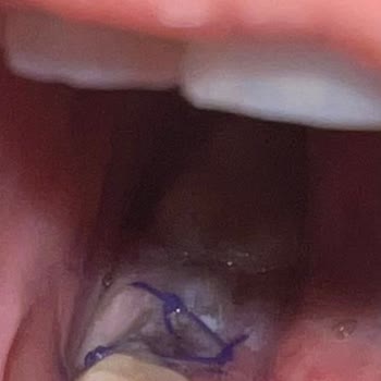 Marmara Üniversitesi Diş Hekimliği Fakültesi Kırık Diş Parçası Bıraktı