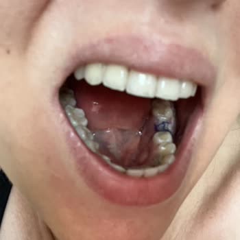 Marmara Üniversitesi Diş Hekimliği Fakültesi Kırık Diş Parçası Bıraktı