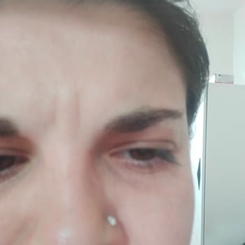 Estpoint Espoint Botoks Mağduriyeti