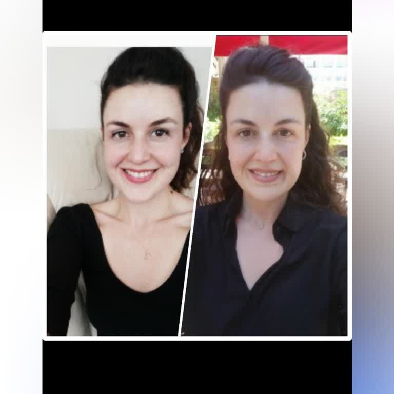 Dr. Can Taşkıran Masseter Botoks Sonrası Gülüş Asimetrisi